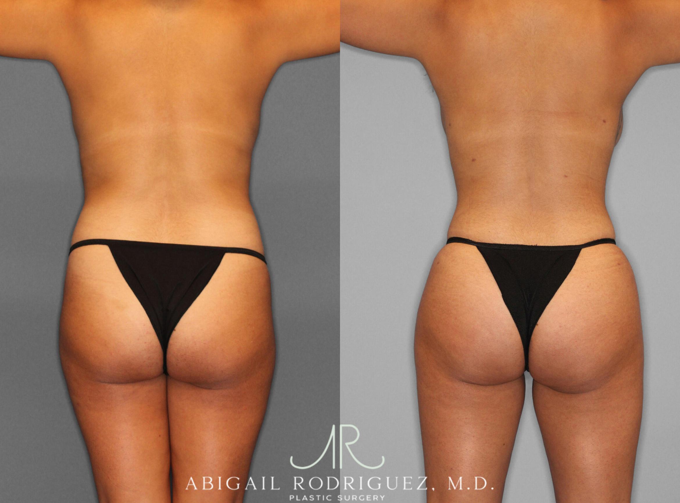 Before & After Fat Grafting Case 253937 View 4 View in Houston, TX