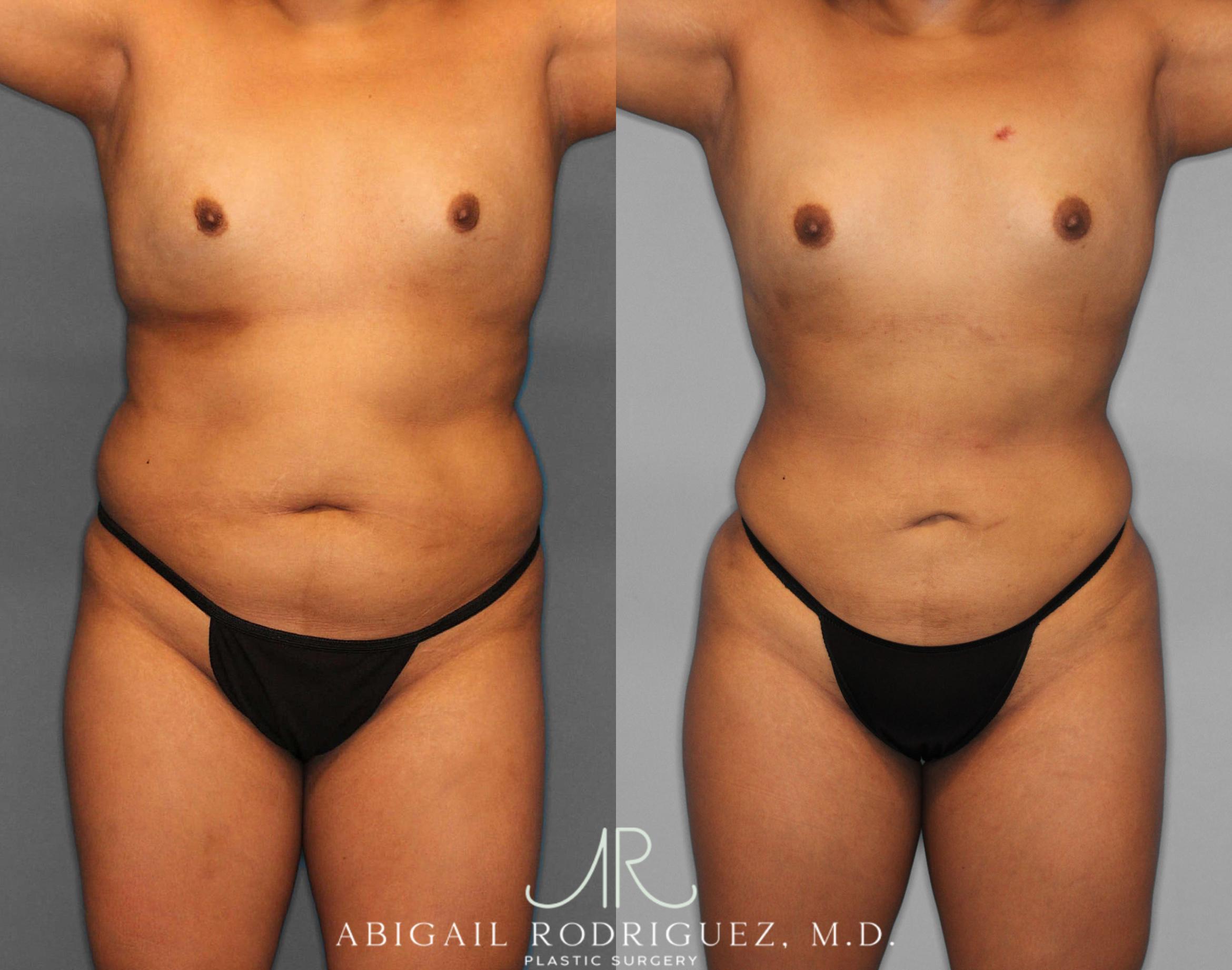Before & After Fat Grafting Case 254518 View 1 View in Houston, TX