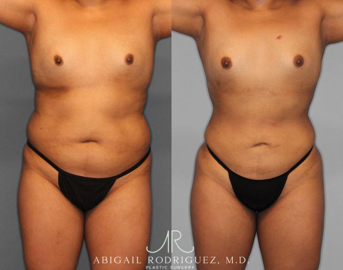 Before & After Fat Grafting Case 254518 View 1 View in Houston, TX