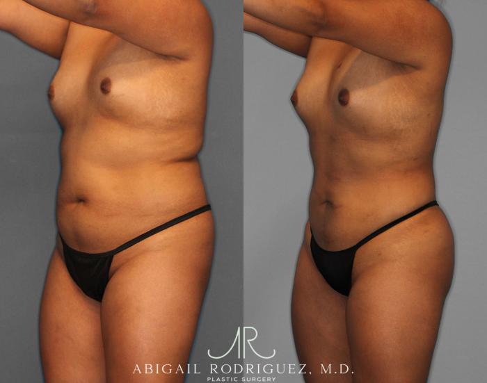 Before & After Fat Grafting Case 254518 View 2 View in Houston, TX
