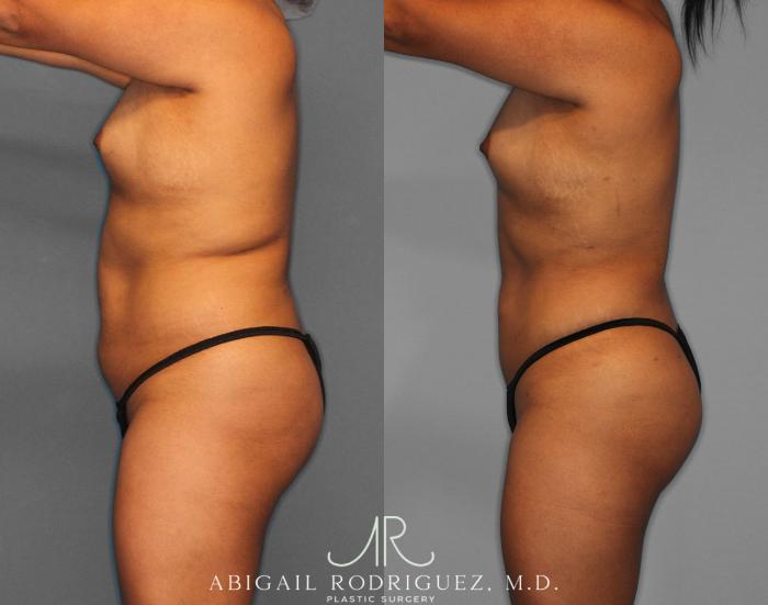 Before & After Fat Grafting Case 254518 View 3 View in Houston, TX