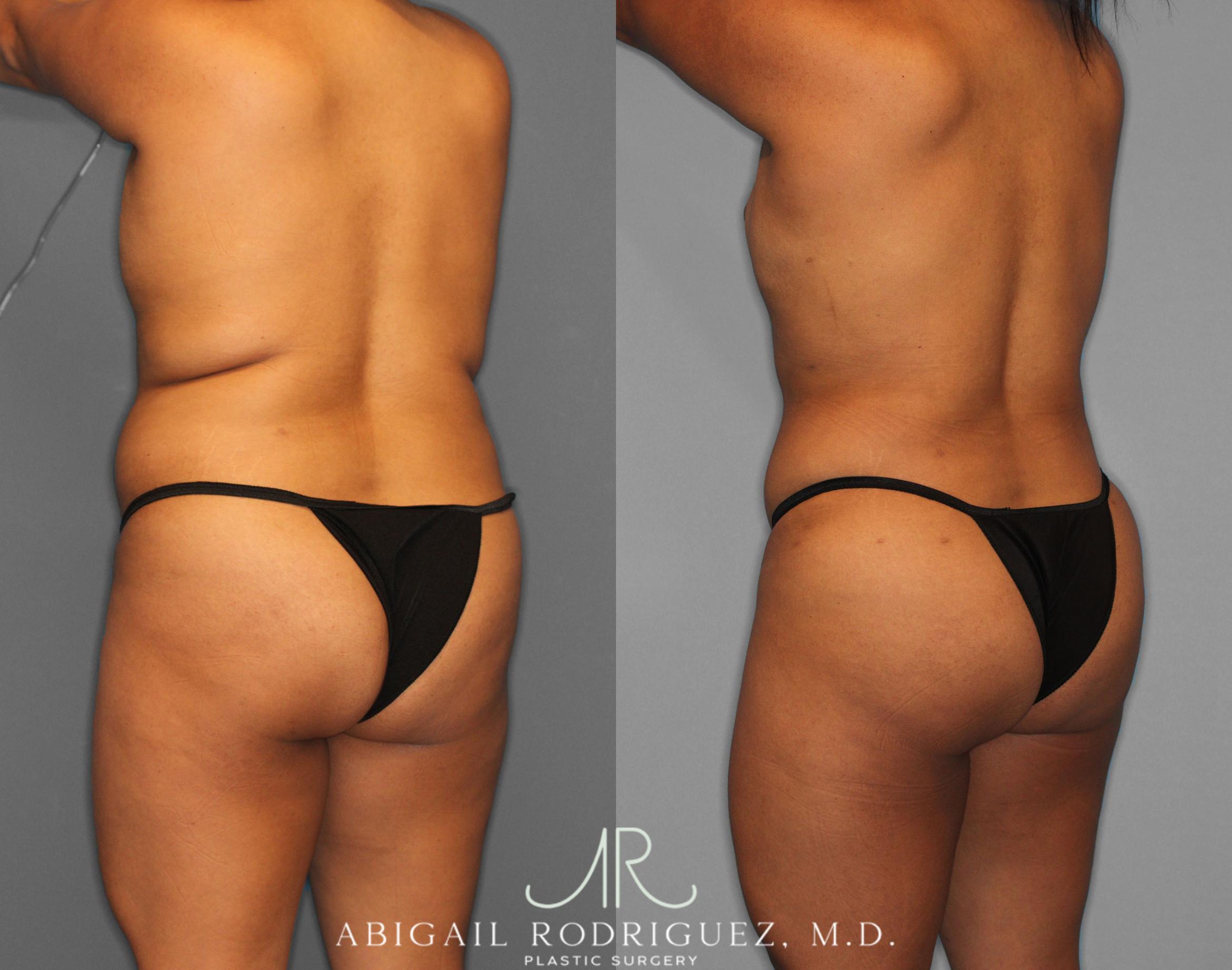 Before & After Fat Grafting Case 254518 View 4 View in Houston, TX