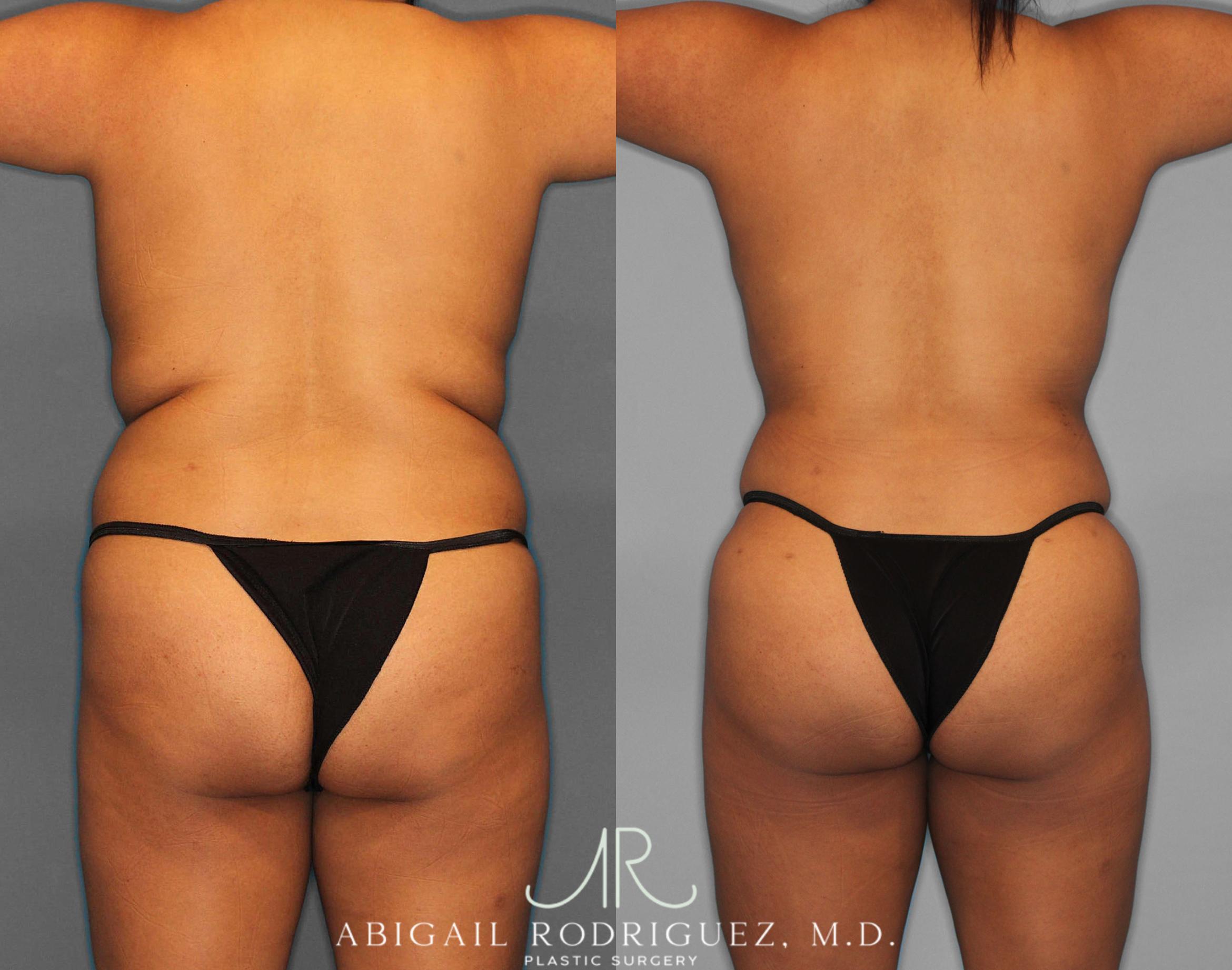 Before & After Fat Grafting Case 254518 View 5 View in Houston, TX
