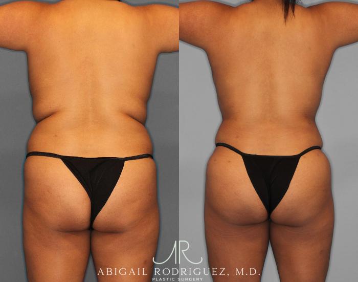 Before & After Fat Grafting Case 254518 View 5 View in Houston, TX