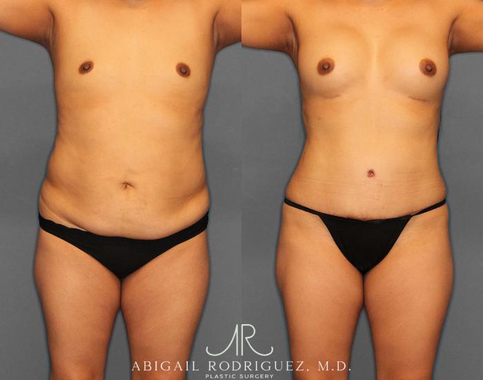Before & After Tummy Tuck Case 254522 View 1 View in Houston, TX