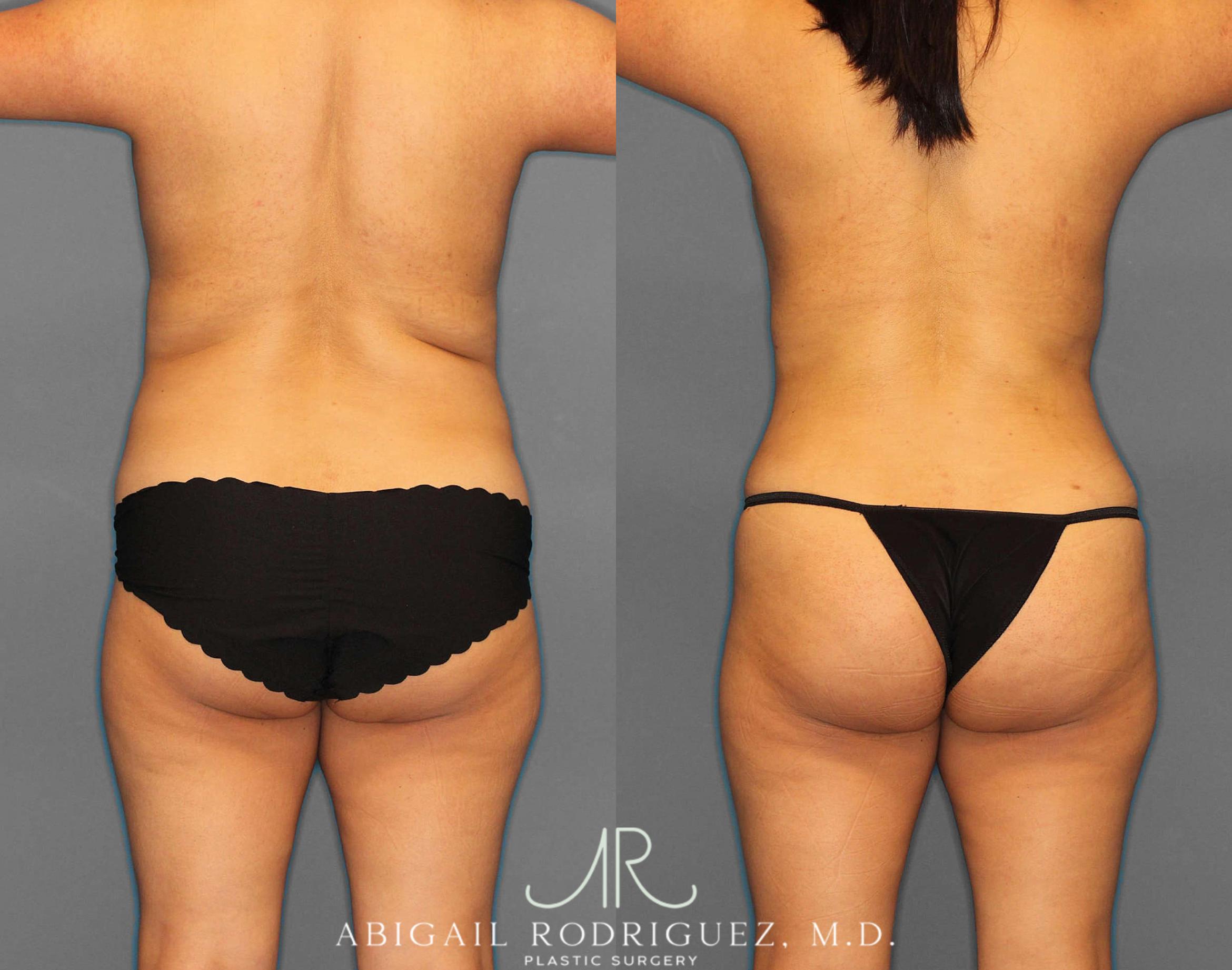Before & After Fat Grafting Case 254522 View 4 View in Houston, TX