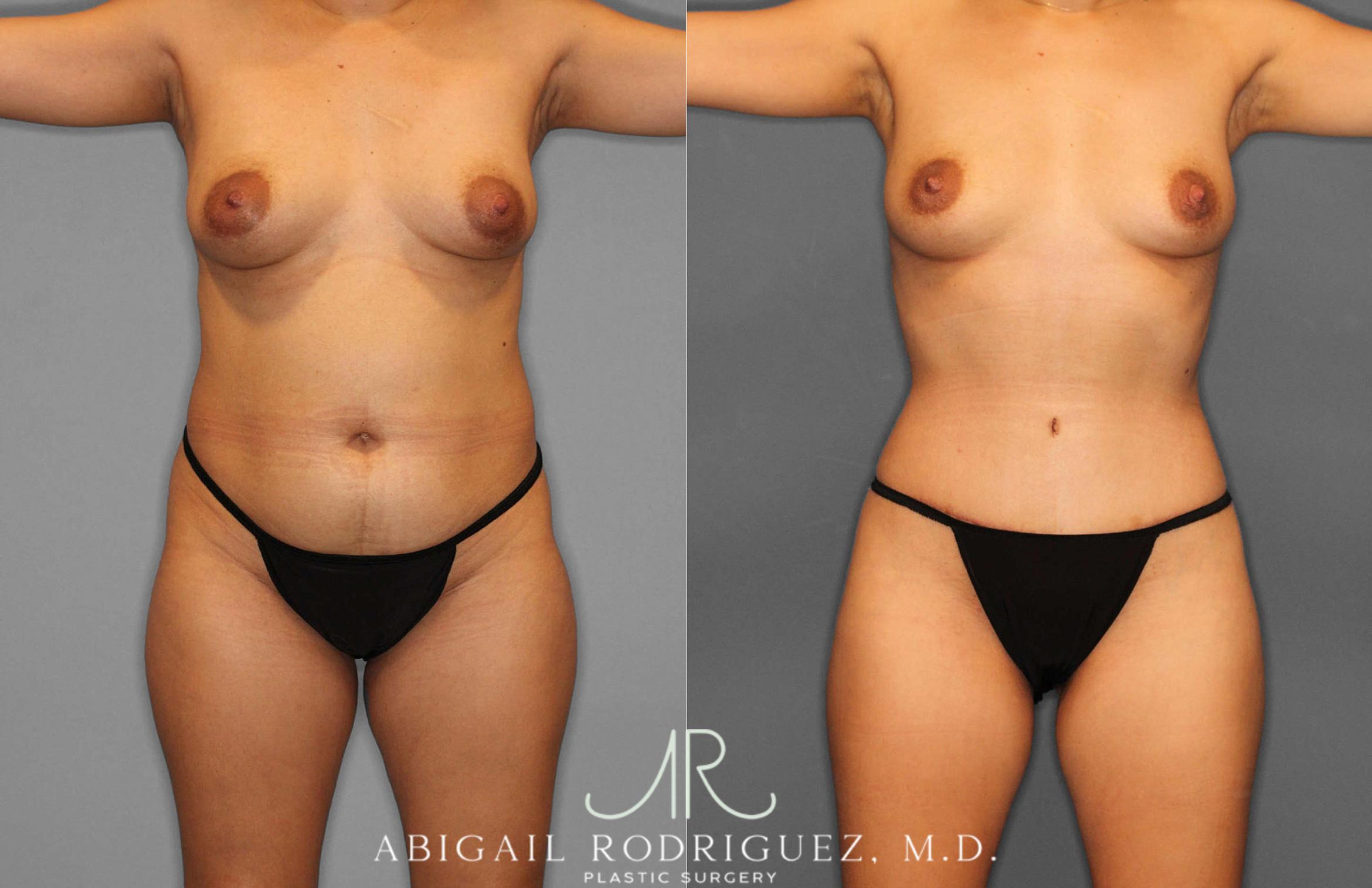 Before & After Fat Grafting Case 254837 View 1 View in Houston, TX