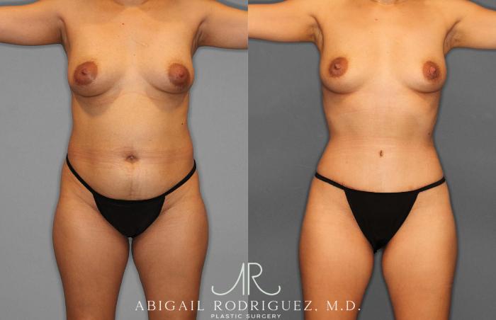 Before & After Fat Grafting Case 254837 View 1 View in Houston, TX