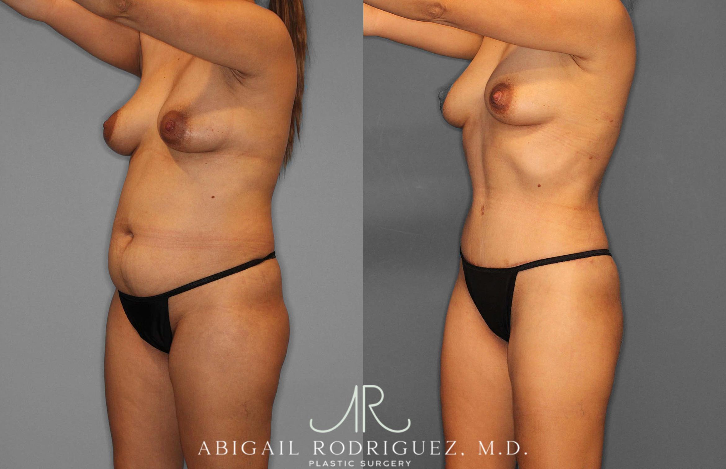 Before & After Fat Grafting Case 254837 View 2 View in Houston, TX