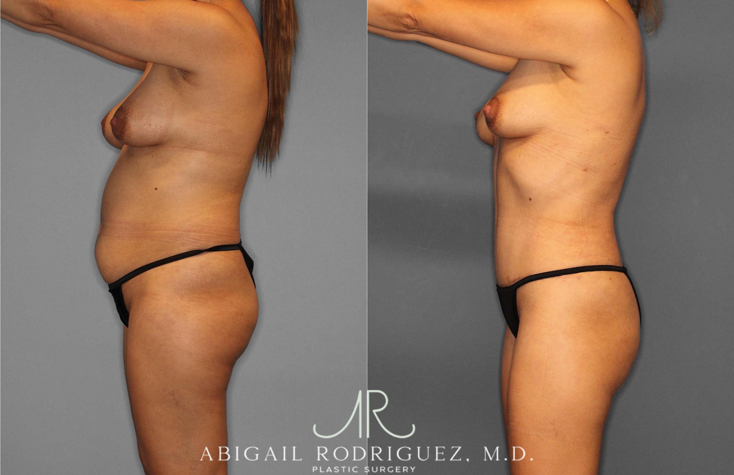 Before & After Fat Grafting Case 254837 View 3 View in Houston, TX
