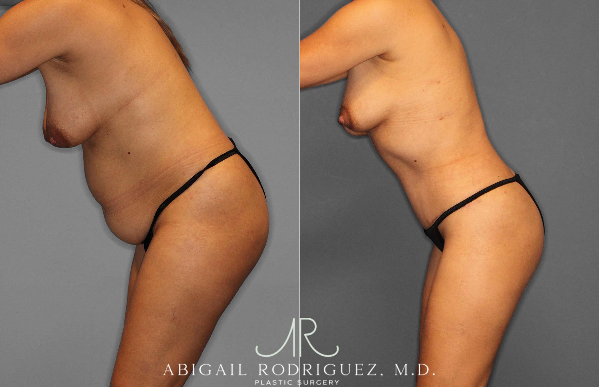 Before & After Fat Grafting Case 254837 View 4 View in Houston, TX