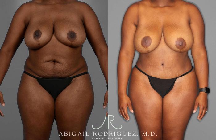 Before & After Fat Grafting Case 255276 View 1 View in Houston, TX