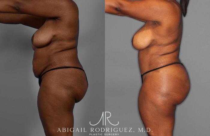 Before & After Fat Grafting Case 255276 View 2 View in Houston, TX