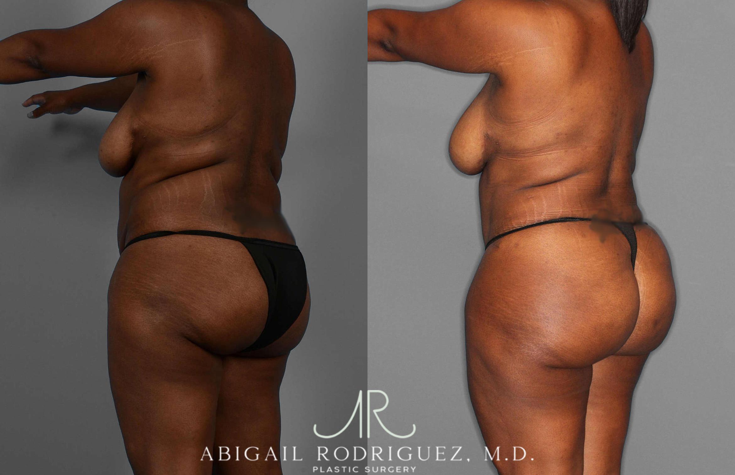 Before & After Fat Grafting Case 255276 View 3 View in Houston, TX