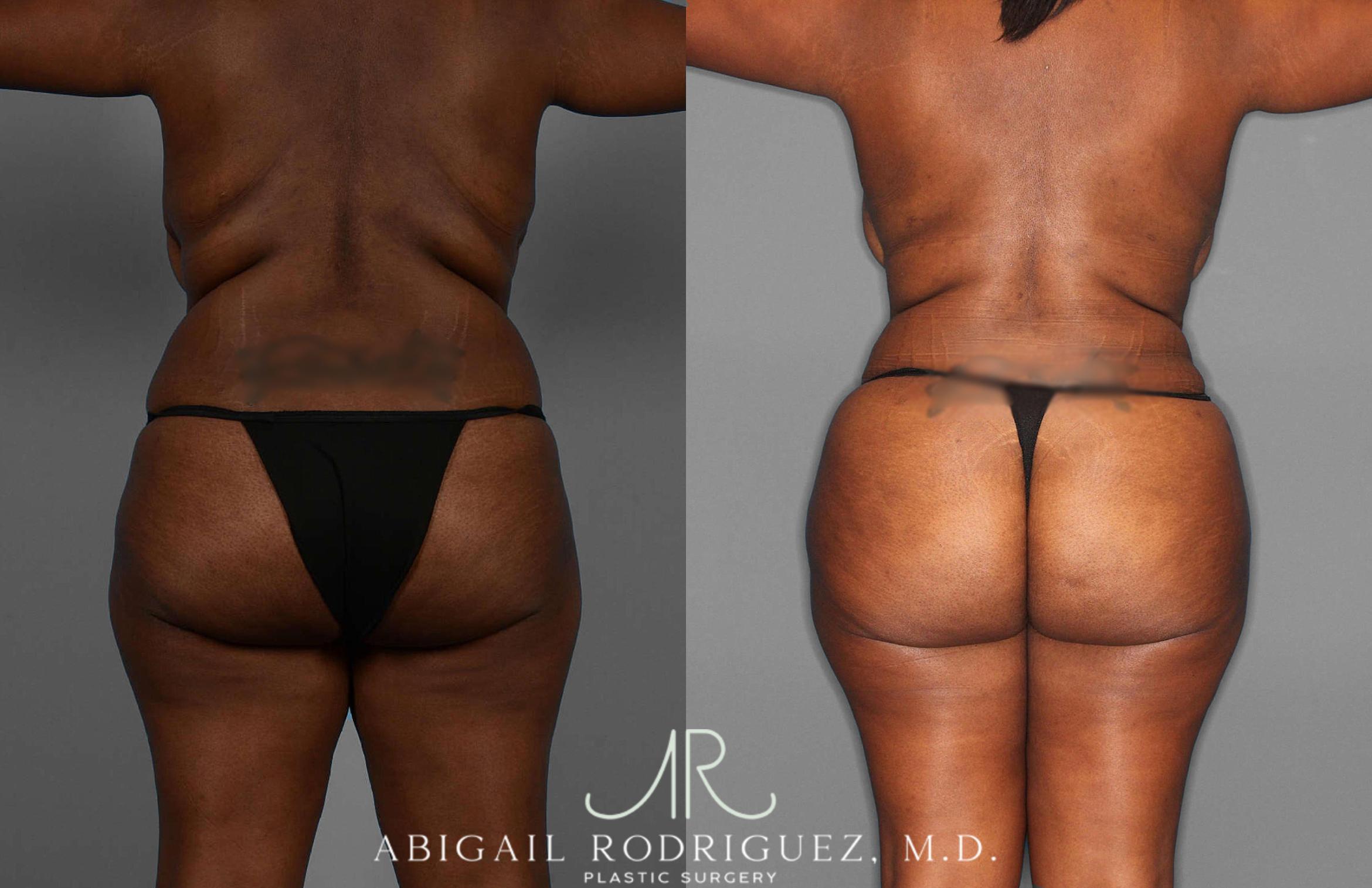 Before & After Fat Grafting Case 255276 View 4 View in Houston, TX
