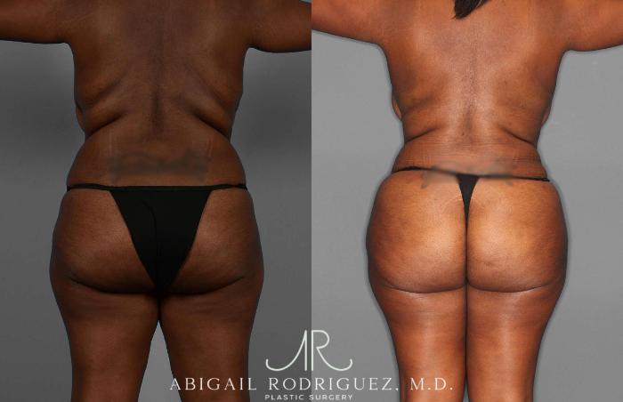 Before & After Fat Grafting Case 255276 View 4 View in Houston, TX