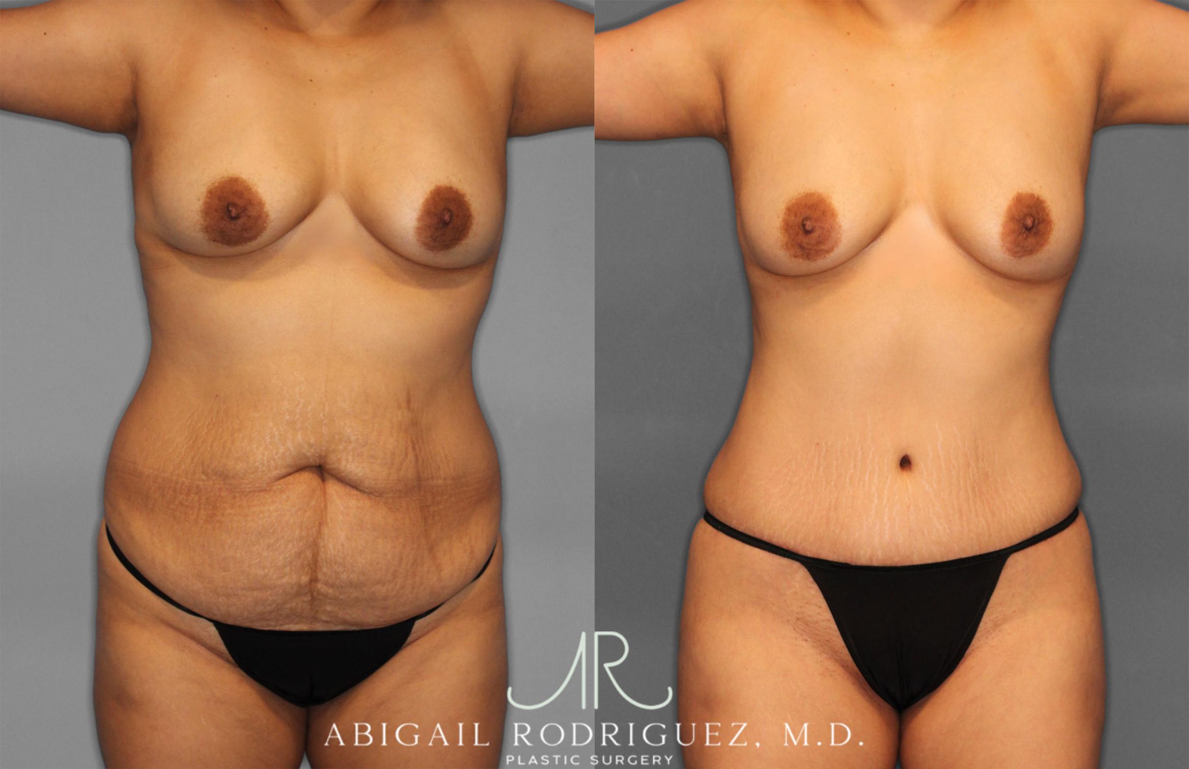 Before & After Fat Grafting Case 257321 View 1 View in Houston, TX