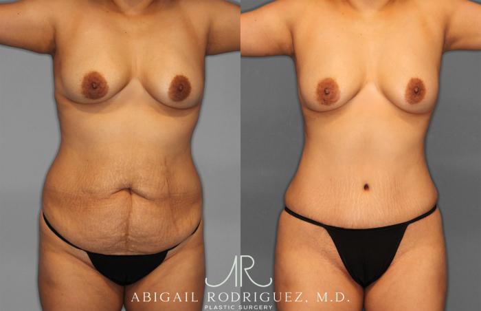 Before & After Fat Grafting Case 257321 View 1 View in Houston, TX