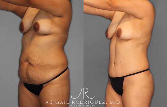 Before & After Fat Grafting Case 257321 View 2 View in Houston, TX
