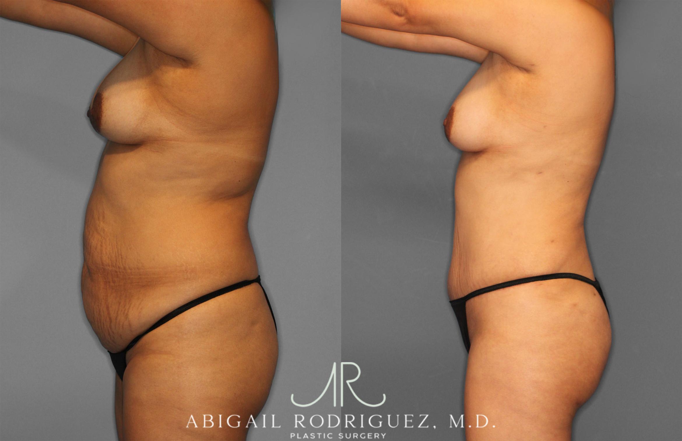 Before & After Fat Grafting Case 257321 View 3 View in Houston, TX