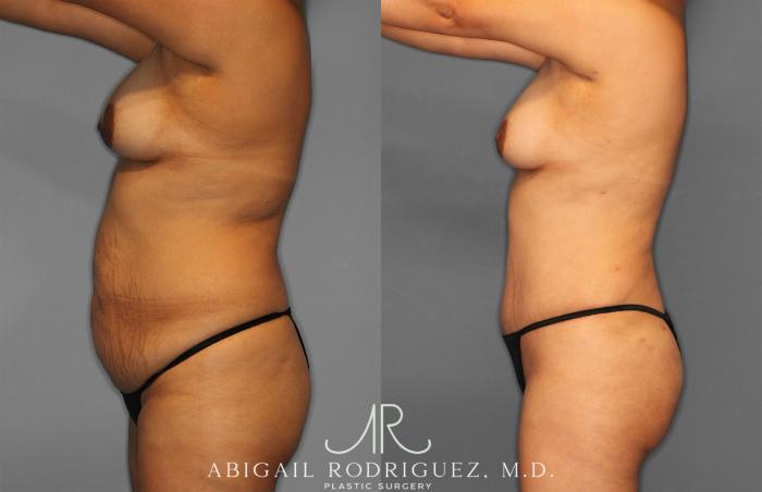 Before & After Fat Grafting Case 257321 View 3 View in Houston, TX