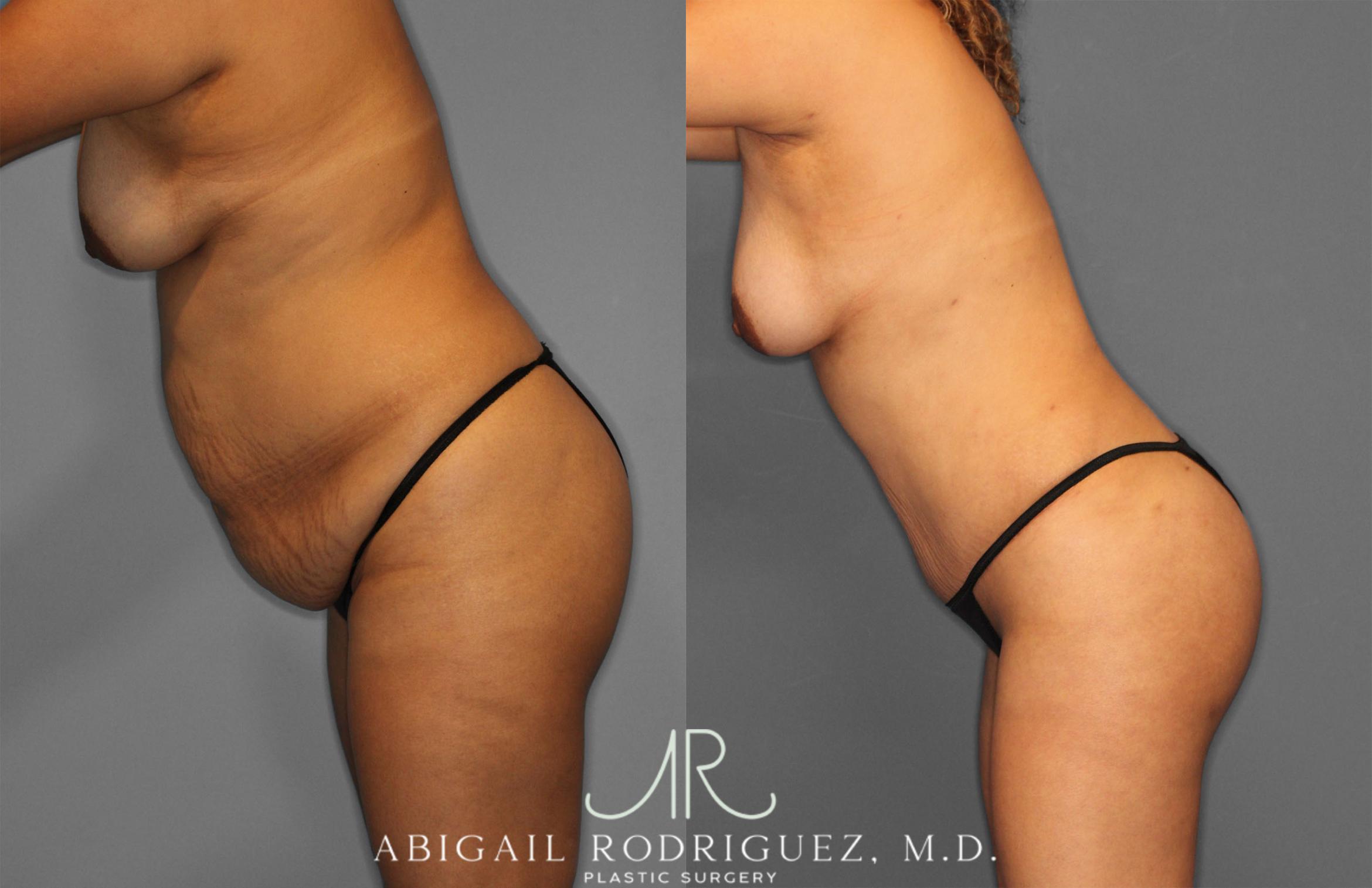 Before & After Fat Grafting Case 257321 View 4 View in Houston, TX