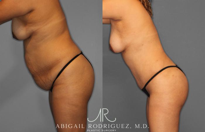 Before & After Fat Grafting Case 257321 View 4 View in Houston, TX