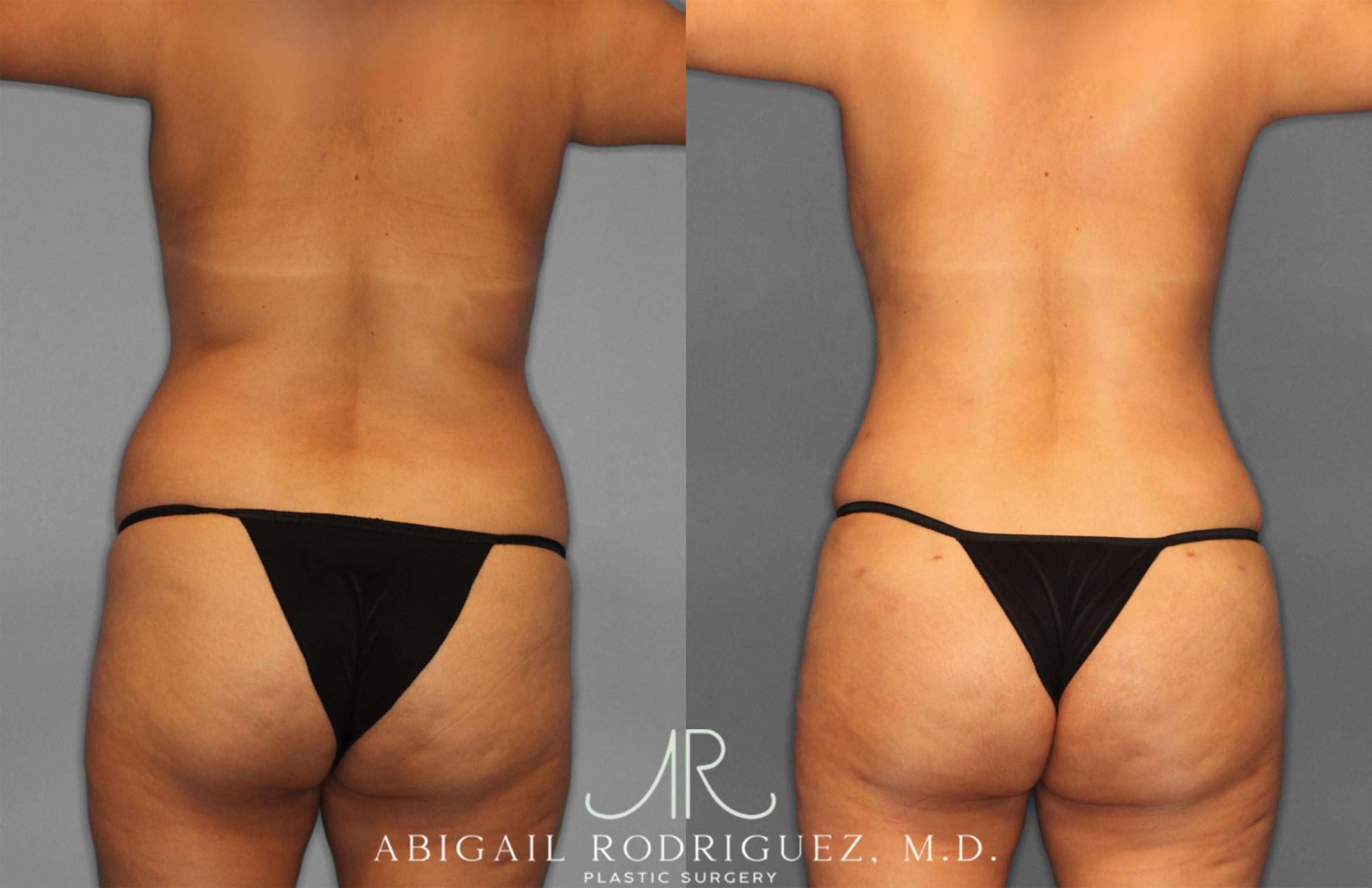 Before & After Fat Grafting Case 257321 View 5 View in Houston, TX