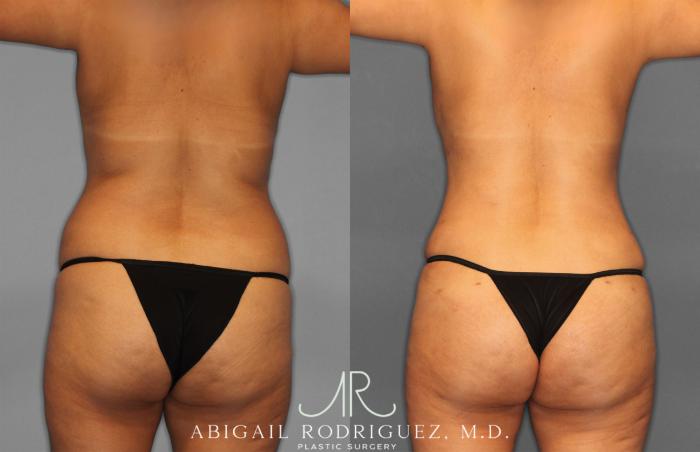 Before & After Fat Grafting Case 257321 View 5 View in Houston, TX