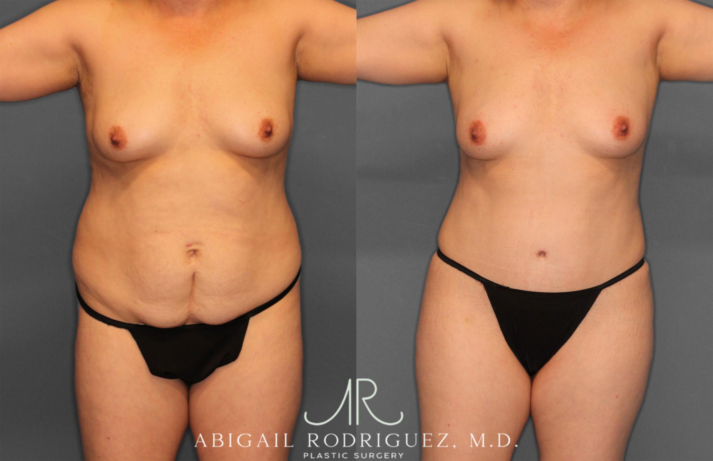 Before & After Fat Grafting Case 257487 View 1 View in Houston, TX