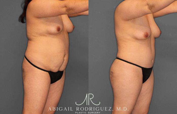 Before & After Fat Grafting Case 257487 View 10 View in Houston, TX