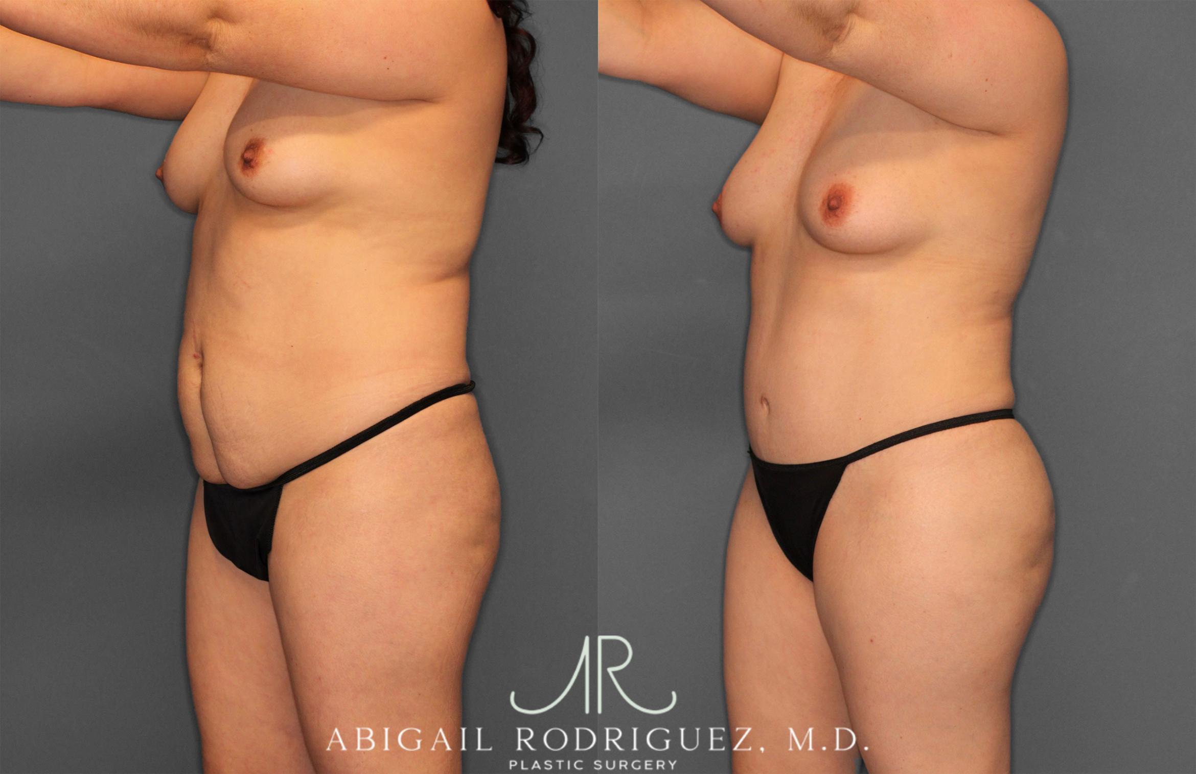 Before & After Fat Grafting Case 257487 View 2 View in Houston, TX