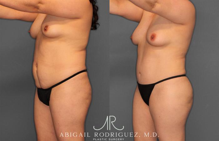 Before & After Fat Grafting Case 257487 View 2 View in Houston, TX