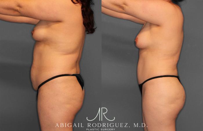 Before & After Fat Grafting Case 257487 View 3 View in Houston, TX