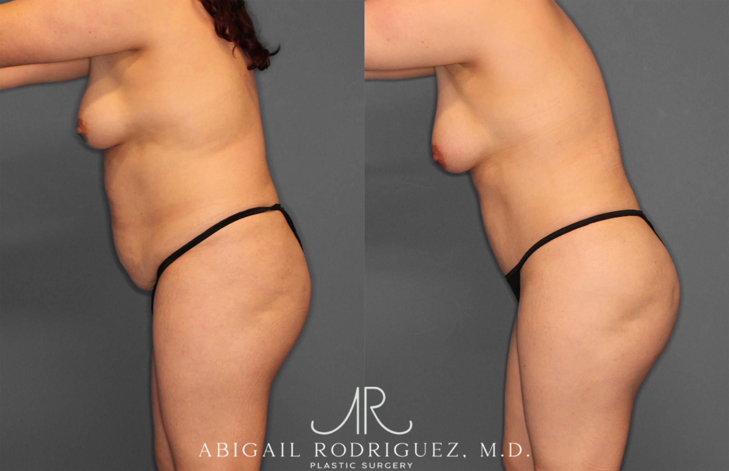 Before & After Fat Grafting Case 257487 View 4 View in Houston, TX