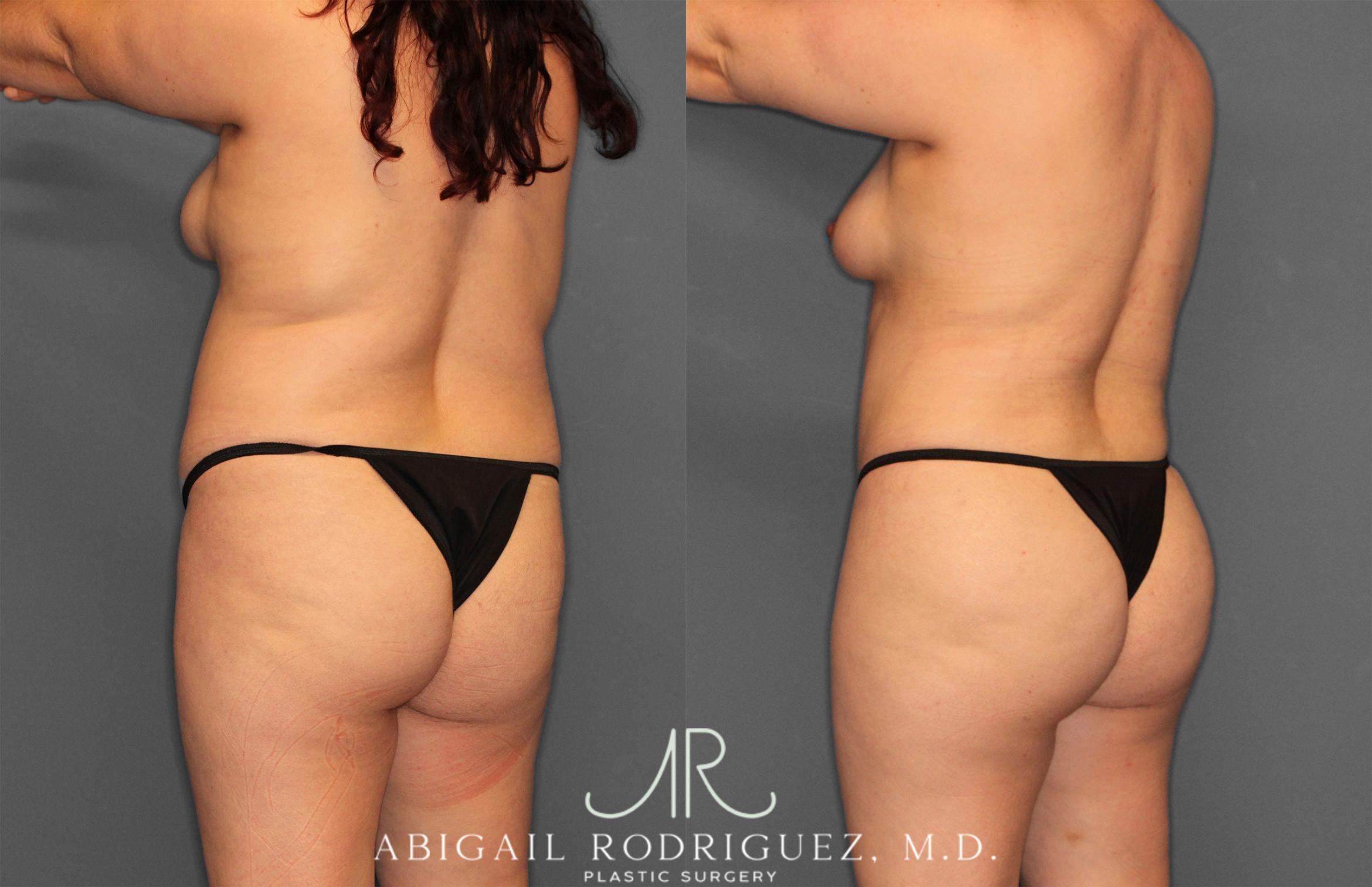 Before & After Fat Grafting Case 257487 View 5 View in Houston, TX
