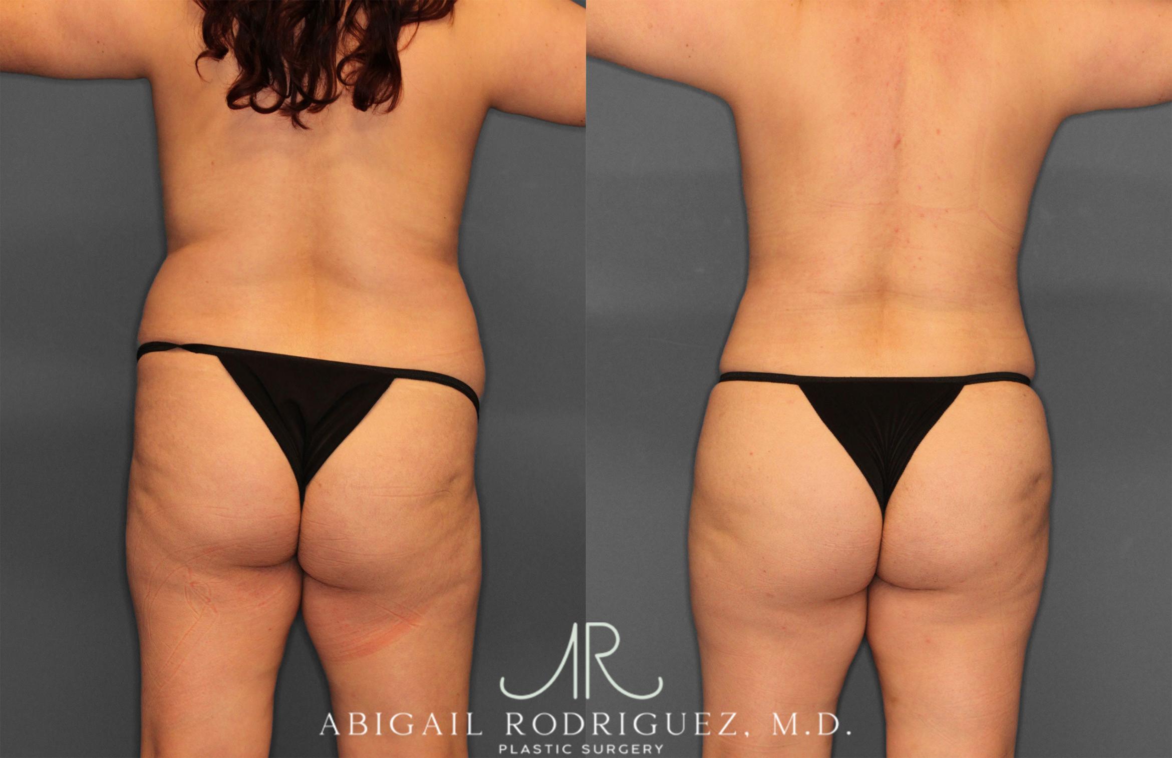 Before & After Fat Grafting Case 257487 View 6 View in Houston, TX