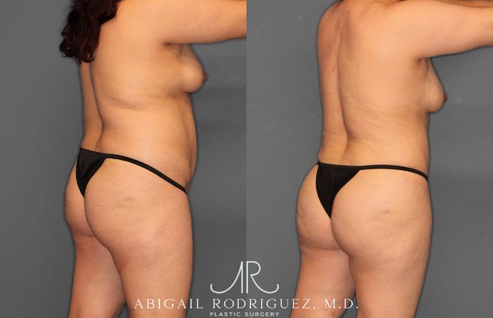 Before & After Fat Grafting Case 257487 View 7 View in Houston, TX