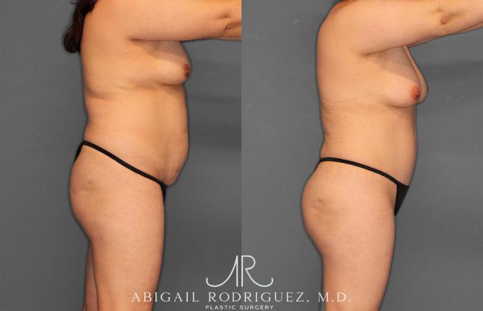 Before & After Fat Grafting Case 257487 View 8 View in Houston, TX