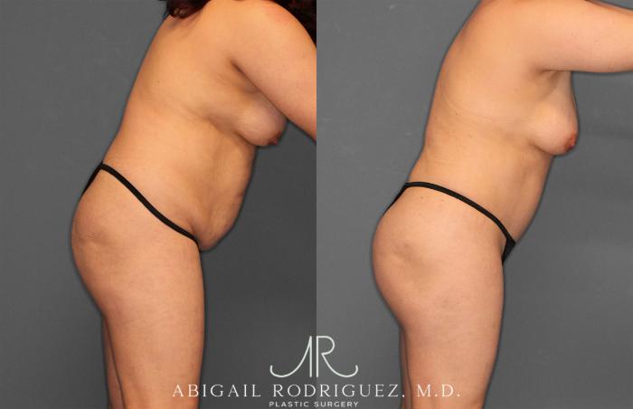 Before & After Fat Grafting Case 257487 View 9 View in Houston, TX
