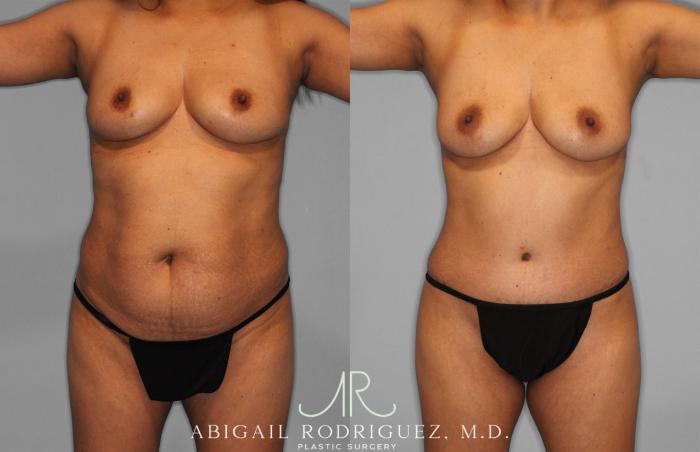 Before & After Liposuction Case 257521 View 1 View in Houston, TX