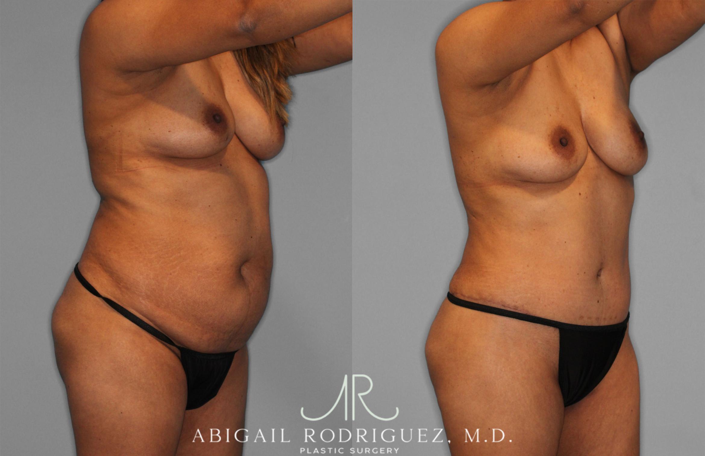 Before & After Fat Grafting Case 257521 View 10 View in Houston, TX