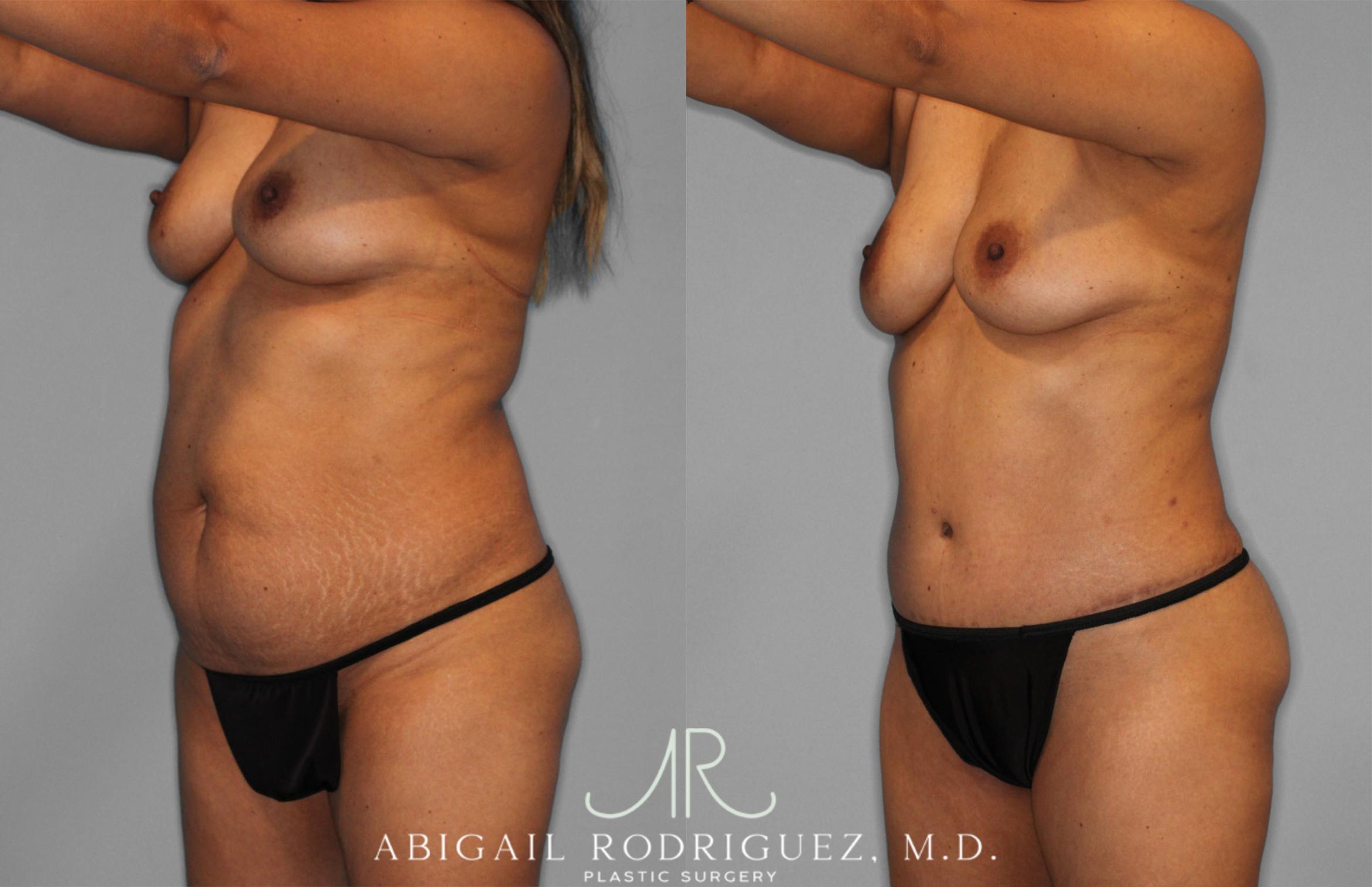 Before & After Fat Grafting Case 257521 View 2 View in Houston, TX