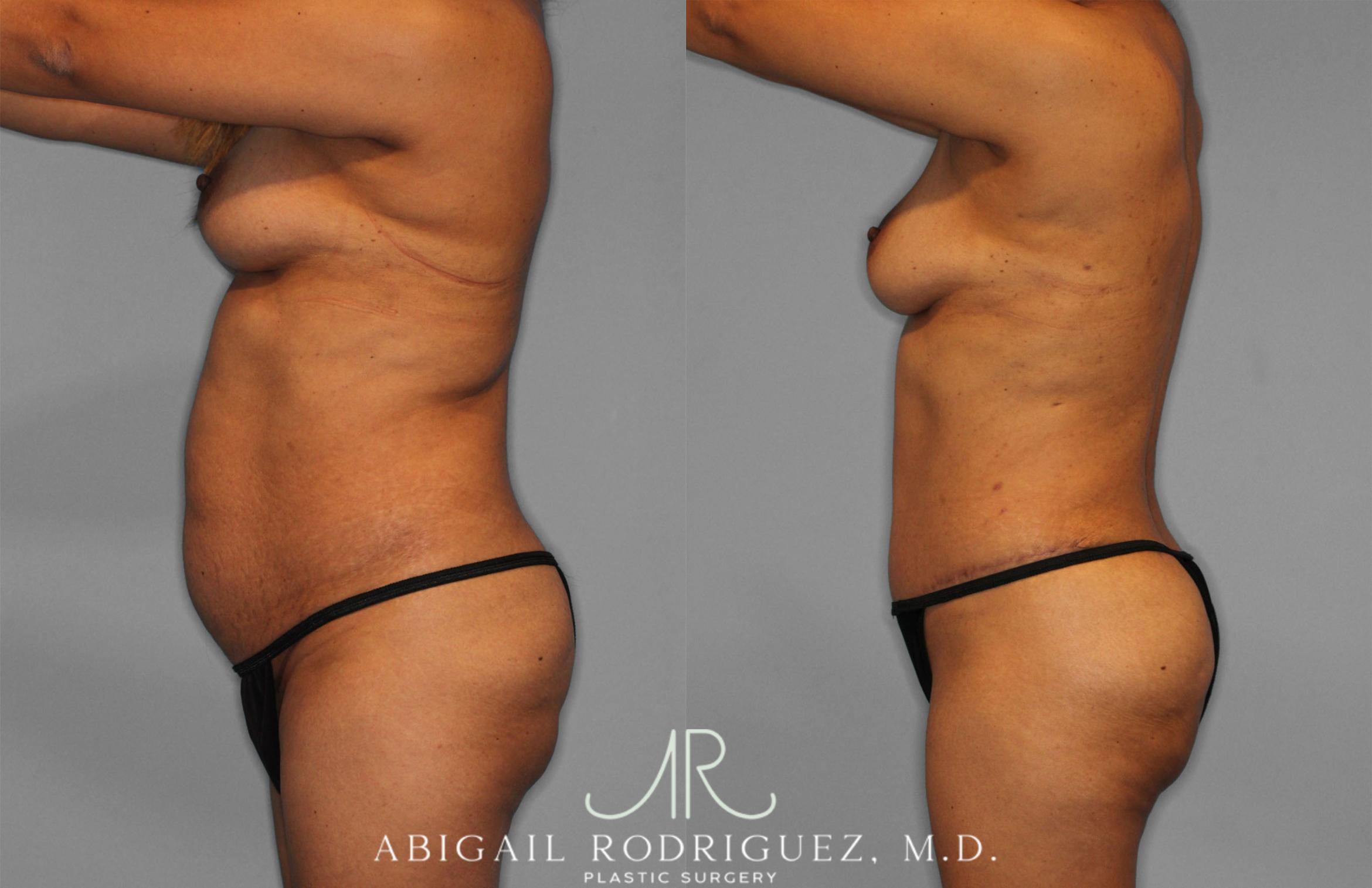 Before & After Fat Grafting Case 257521 View 3 View in Houston, TX