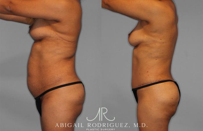 Before & After Fat Grafting Case 257521 View 3 View in Houston, TX