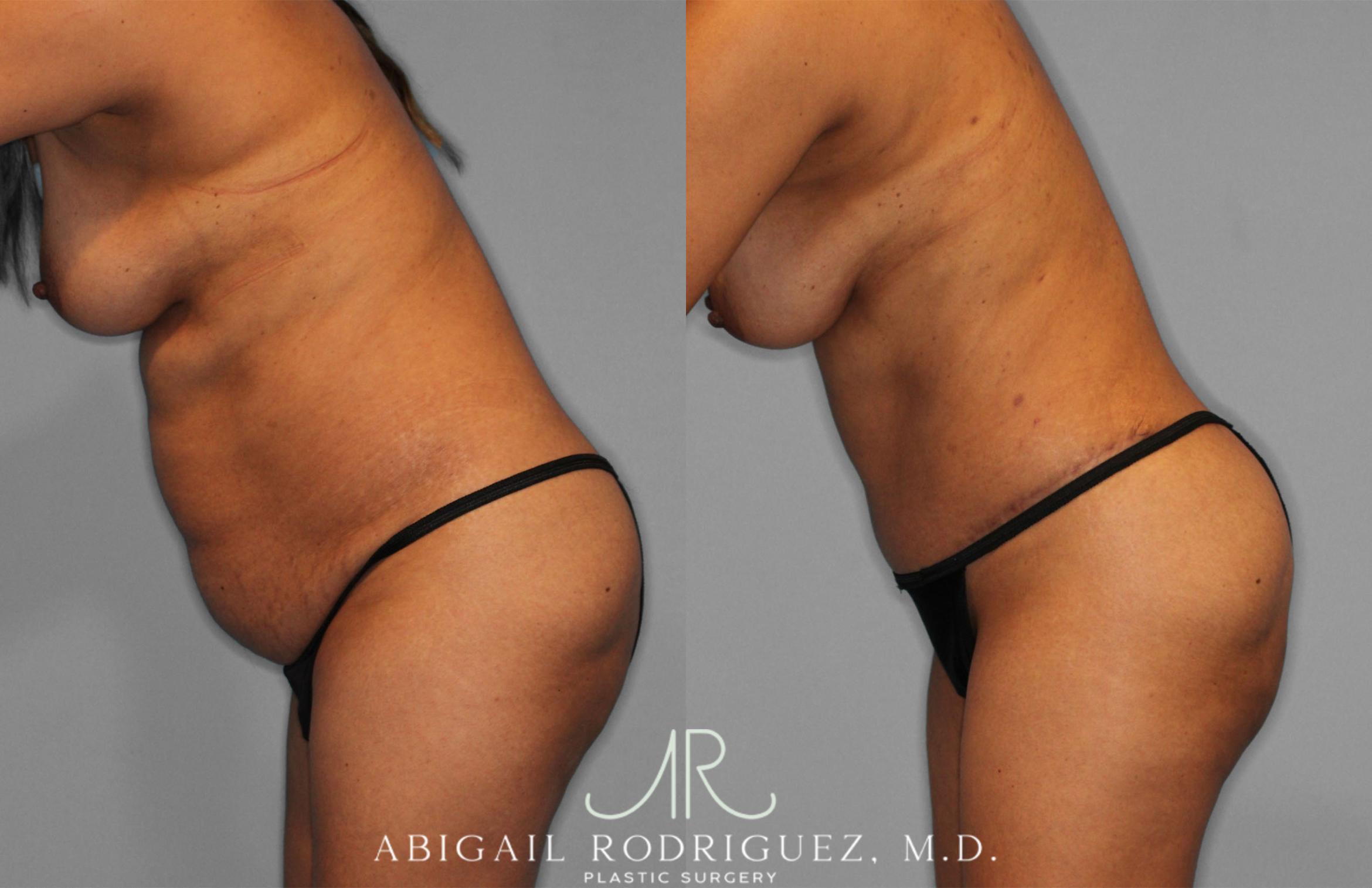 Before & After Fat Grafting Case 257521 View 4 View in Houston, TX