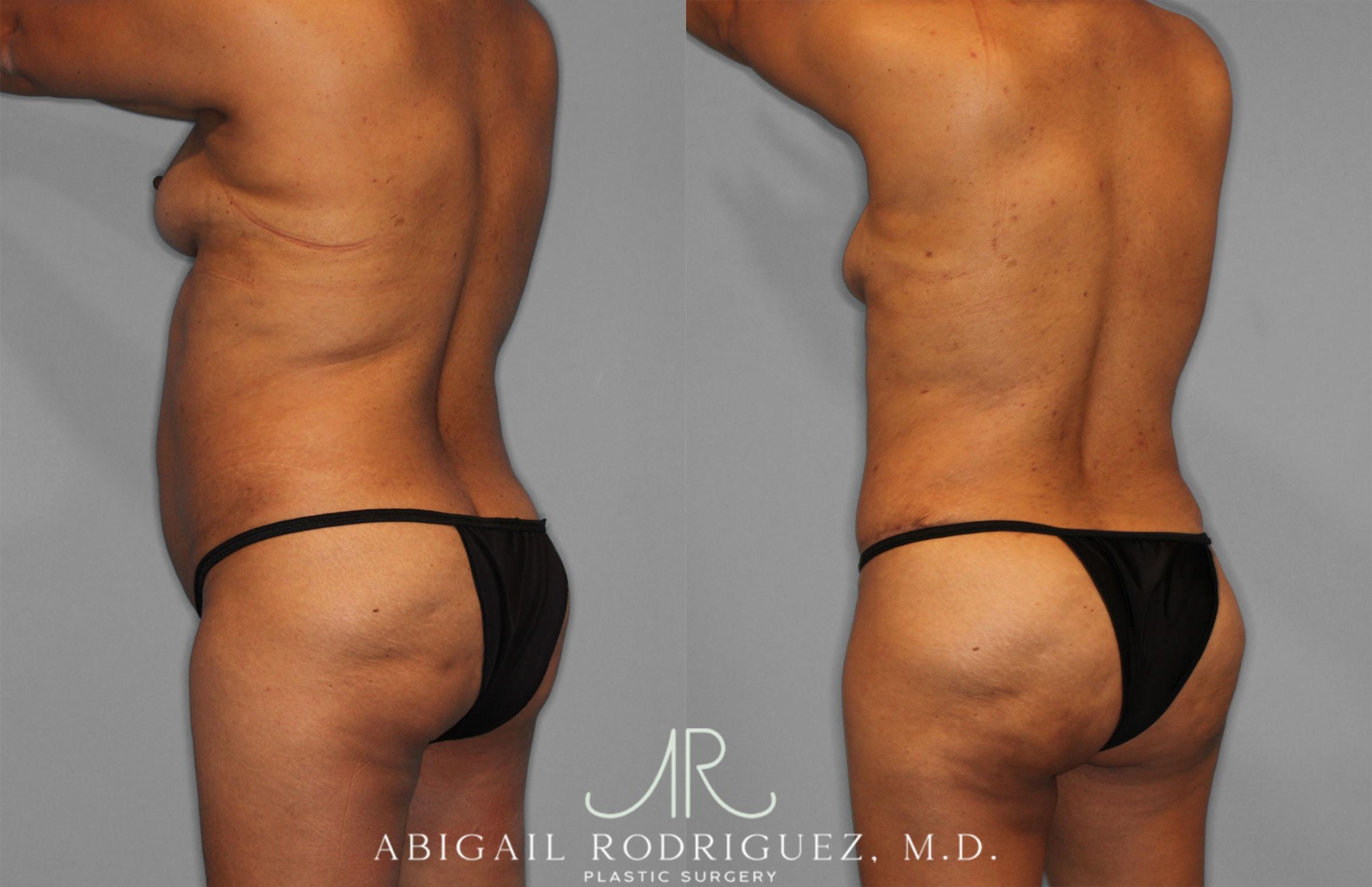 Before & After Fat Grafting Case 257521 View 5 View in Houston, TX