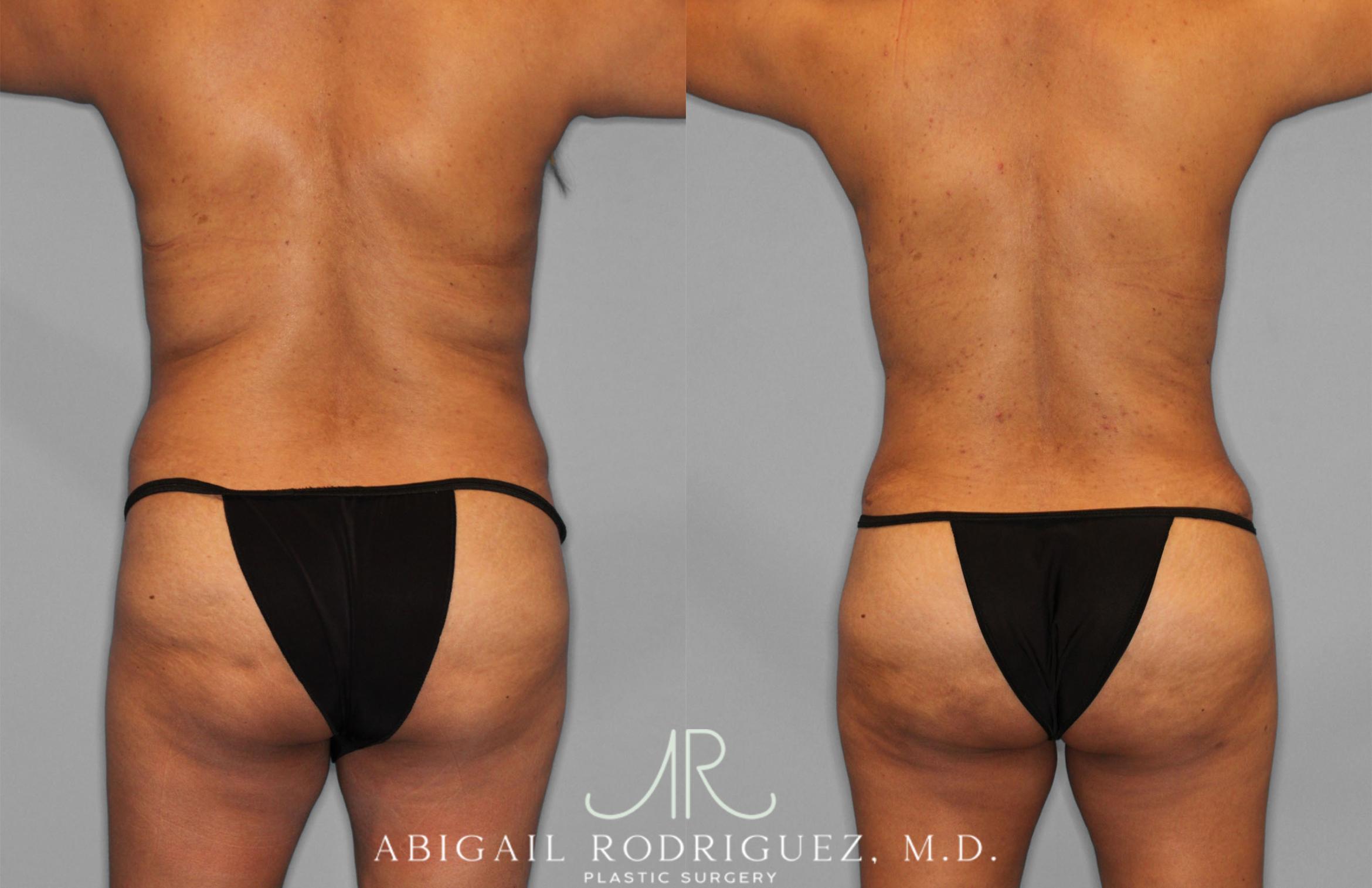 Before & After Fat Grafting Case 257521 View 6 View in Houston, TX