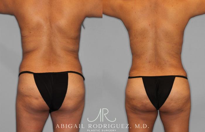 Before & After Fat Grafting Case 257521 View 6 View in Houston, TX