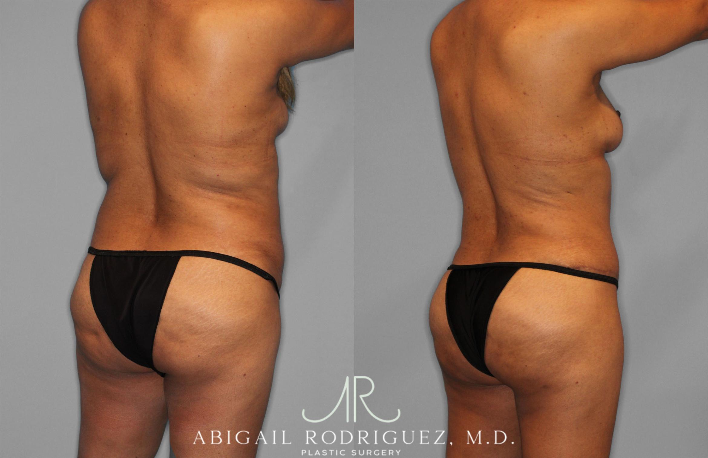 Before & After Fat Grafting Case 257521 View 7 View in Houston, TX